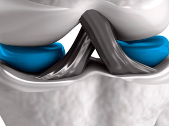 Me duele la rodilla. Yo creo que es el menisco…
