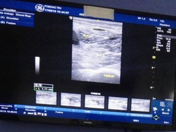 Lesiones musculares parte I