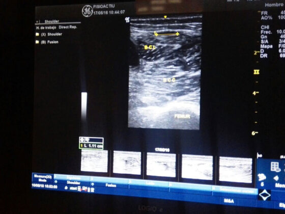 Lesiones musculares parte II